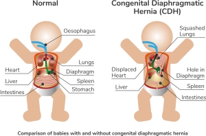 Diagram of the comparison of babies with and without CDH - full description below.
