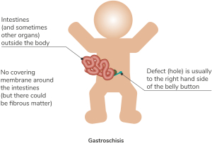 Diagram of Gastroschisis - full description below.